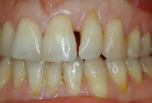 Before: tooth with gap