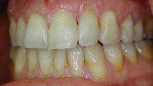 after: closed gap and clean teeth