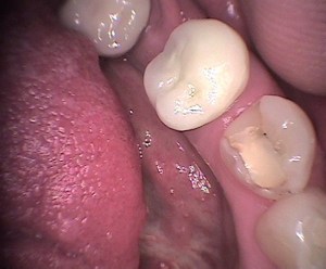 Before: close up of teeth before procedure