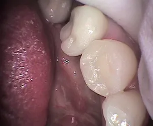 After: close up of teeth after procedure