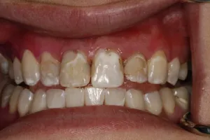 Mouth before Minimally Invasive dental treatment
