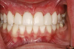 Mouth after Minimally Invasive dental treatment