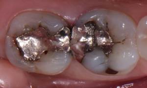 Before: Teeth with amalgam fillings