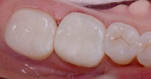 After: Teeth with tooth colored fillings