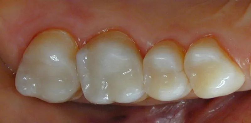 Teeth with new composite fillings