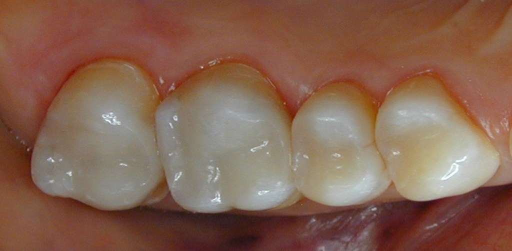 Teeth with new composite fillings