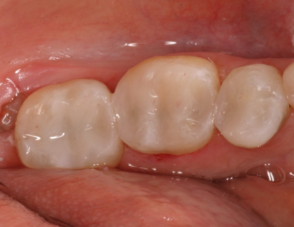 fillings redone with tooth colored composite