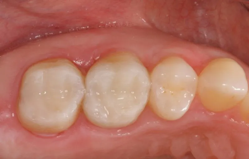 two back teeth with new composite fillings