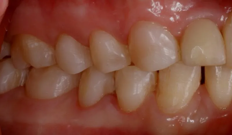 side teeth after repairing decayed teeth with composite resin