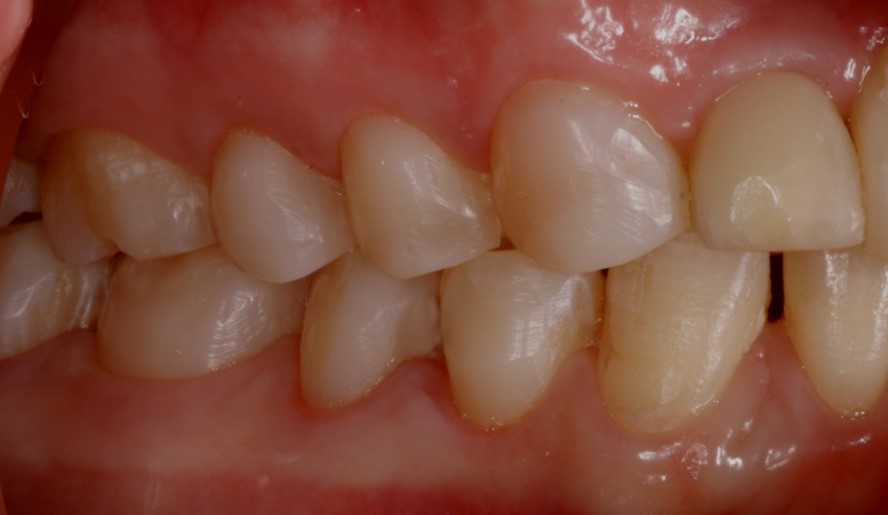 side teeth after repairing decayed teeth with composite resin