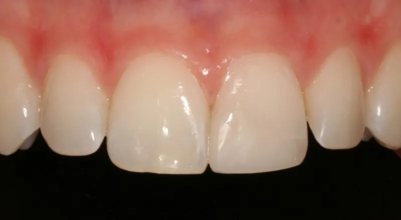 After: fully repaired front tooth