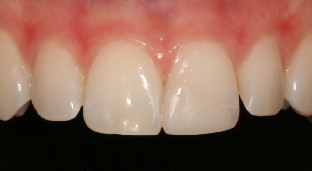 After: fully repaired front tooth