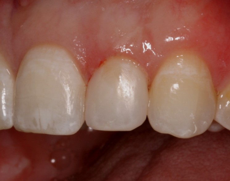 Teeth after dental procedure