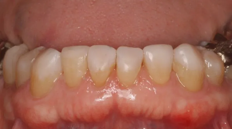 lower front teeth after treatment to rebuild worn teeth