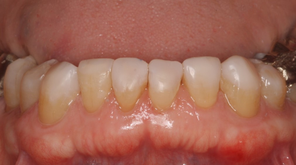 lower front teeth after treatment to rebuild worn teeth