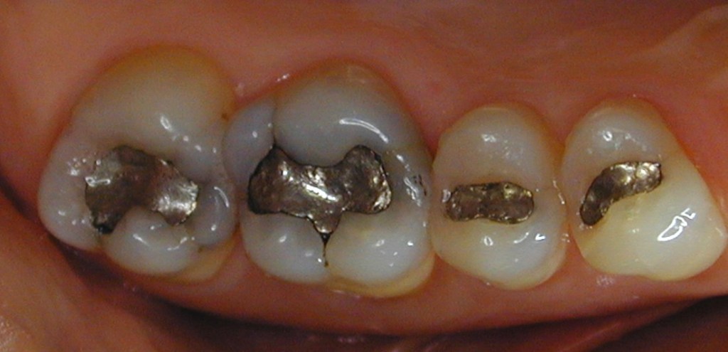 Teeth with mercury fillings before replacement