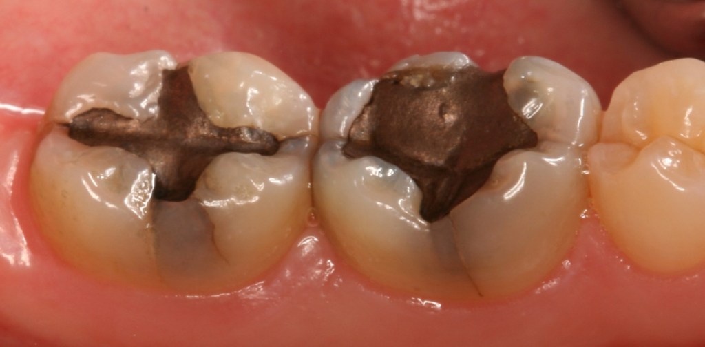 A close up of mercury fillings