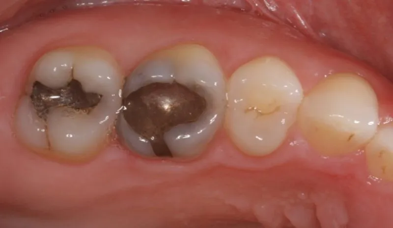 two back teeth with amalgam fillings before replacement