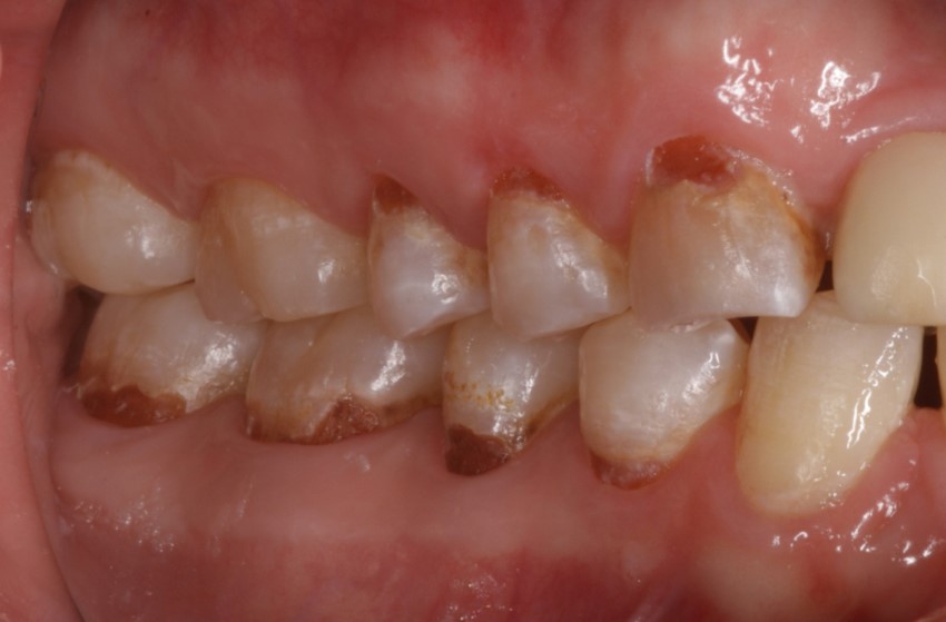 side teeth before repairing decayed teeth with composite resin