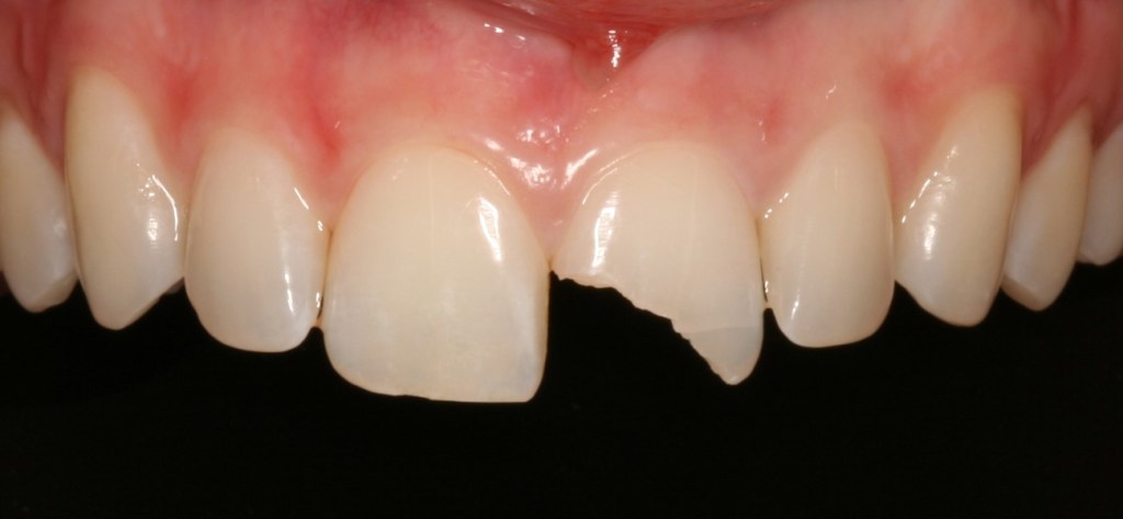 before: broken front tooth