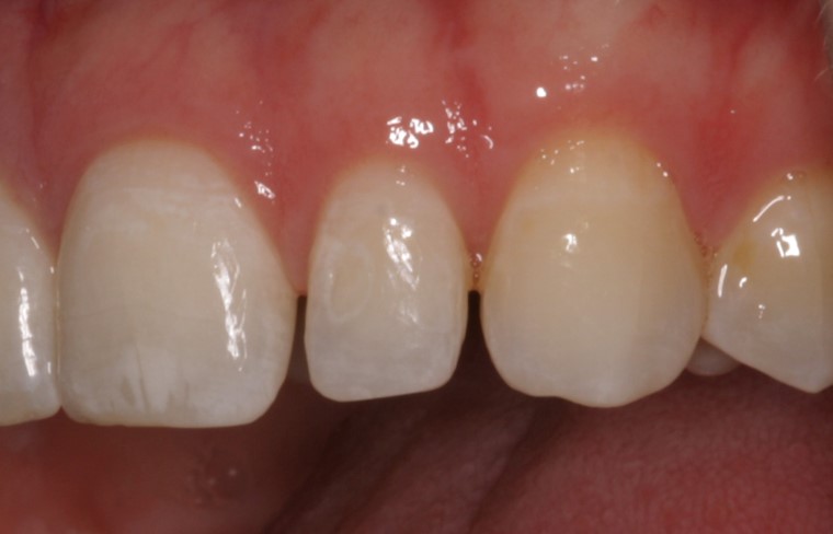 Teeth before dental procedure