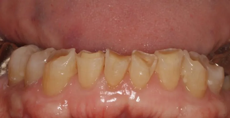lower front teeth before treatment to rebuild worn teeth