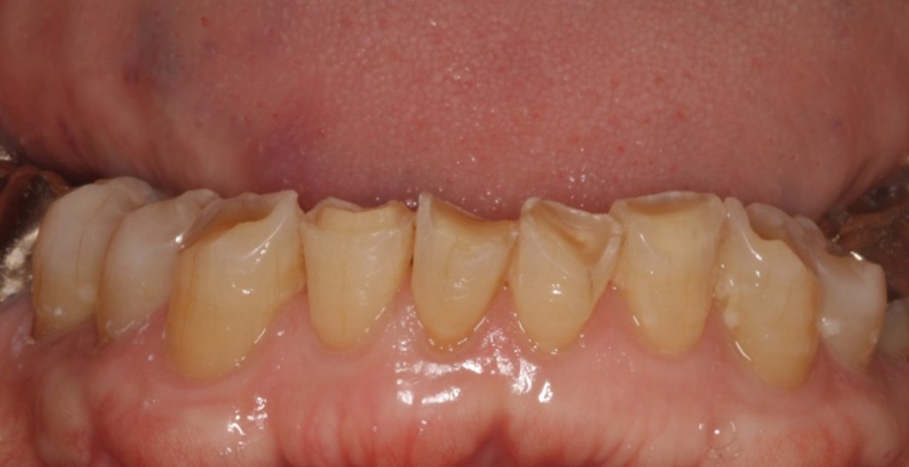 lower front teeth before treatment to rebuild worn teeth